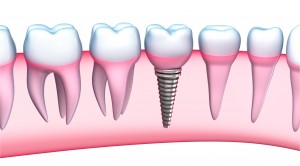 Dental Implant detailed view. 3D Illustration on white background
