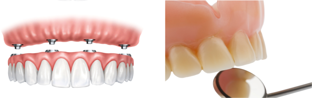 removable dentures