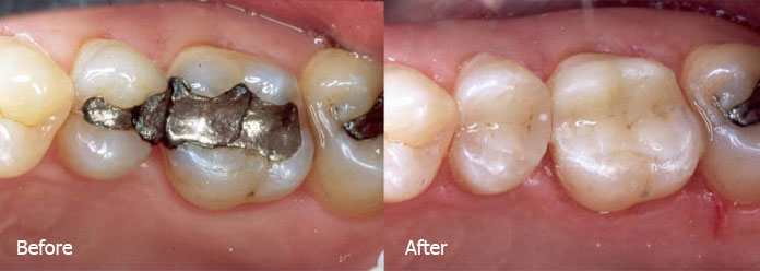 toothcolored fillings