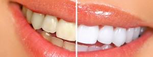 zoom-teeth-whitening-las-vegas (1)